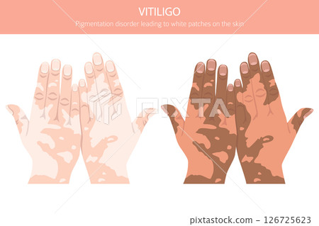 Vitiligo. Skin diseases. Medical infographic design 126725623