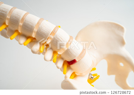 Spinal nerve and bone, Lumbar spine displaced herniated disc fragment, Model for treatment medical in the orthopedic department. 126728672