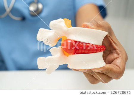 Asian doctor holding spinal nerve and bone model, Lumbar spine displaced herniated disc fragment for treatment medical in the orthopedic department. 126728675