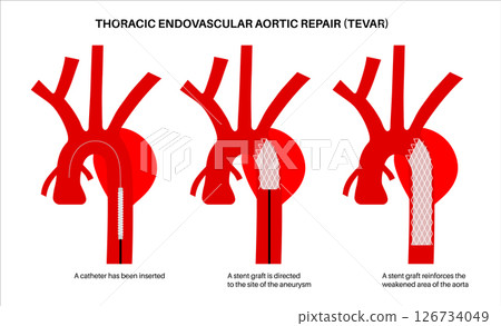 Repair of thoracic aortic aneurysm Repair of thoracic aortic aneurysm 126734049