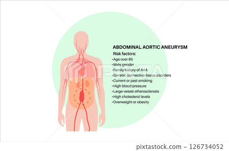 Abdominal Aortic Aneurysm 126734052