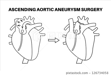 Thoracic aortic aneurysm open surgery 126734058