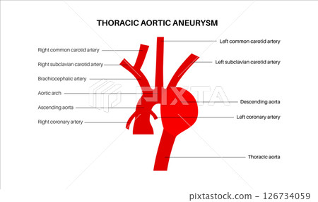 Thoracic aortic aneurysm Thoracic aortic aneurysm 126734059