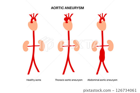 Abdominal Aortic Aneurysm 126734061