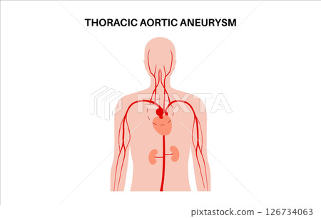 Thoracic aortic aneurysm 126734063