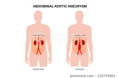 Abdominal Aortic Aneurysm 126734064