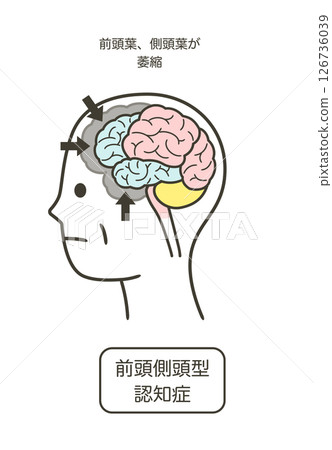 額顳葉失智症受損的大腦部位圖解及其名稱 額顳葉失智症受損的大腦部位圖解及其名稱 126736039