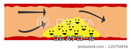 動脈硬化圖 126750656