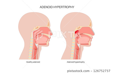 Enlarged adenoids poster Enlarged adenoids poster 126752737