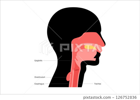 Pharyngoesophageal diverticulum poster Pharyngoesophageal diverticulum poster 126752836