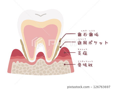 鬆動型牙周病橫切面手繪插圖 鬆動型牙周病橫切面手繪插圖 126763697