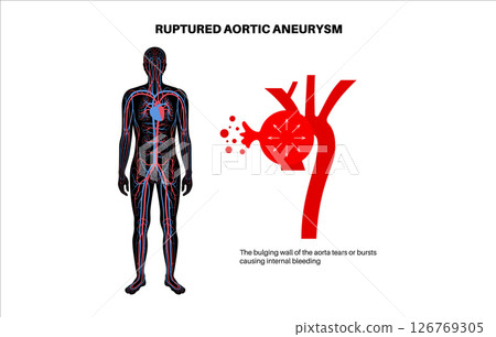 Thoracic aortic aneurysm Thoracic aortic aneurysm 126769305
