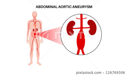 Abdominal Aortic Aneurysm Abdominal Aortic Aneurysm 126769306