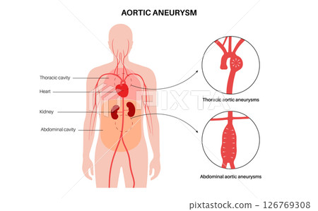 Abdominal Aortic Aneurysm 126769308