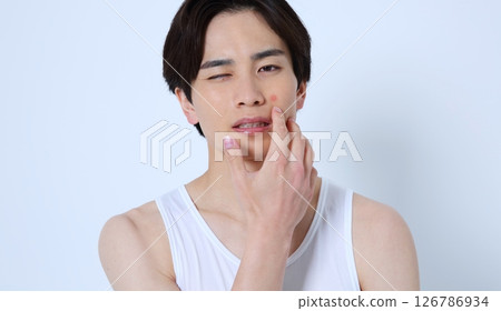 Image of a man suffering from acne and swelling Image of a man suffering from acne and swelling 126786934