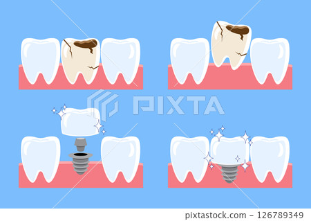 Dental implant procedure installation . Decayed tooth removed and replace by artificial tooth . Flat design cartoon illustration . Isolated on blue background . Vector . 126789349