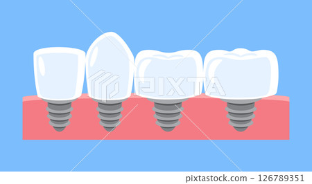 Dental implant . Type of teeth include incisor, canine, premolar and molar . Tooth cartoon illustration . Isolated on blue background . Flat design . Vector . 126789351