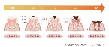 蛀牙過程的圖示 126796168