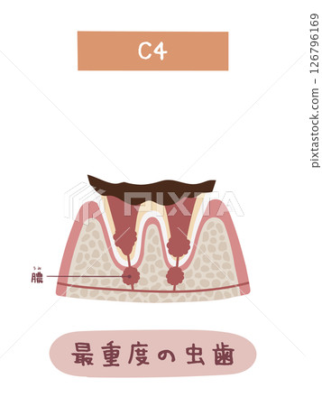 蛀牙過程中 C4 的圖示 蛀牙過程中 C4 的圖示 126796169