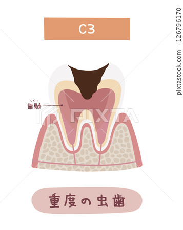 蛀牙過程中C3的圖示 126796170