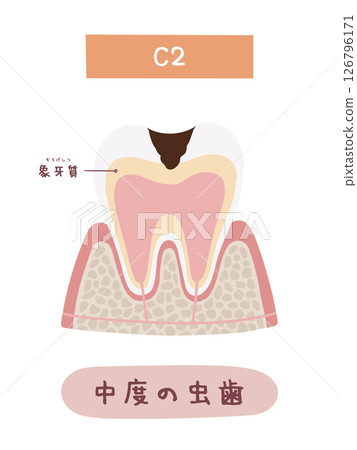 蛀牙過程中C2的圖示 126796171