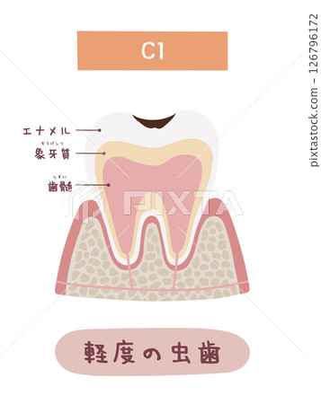 C1 蛀牙過程的圖示 C1 蛀牙過程的圖示 126796172