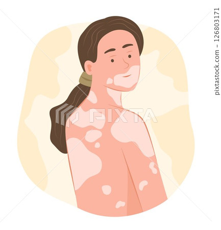 Young Woman with Vitiligo Disease on Body Skin for Dermatological Symptom Concept Illustration Clip Art 126803171