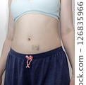 Closeup Human Abdominal Area And Hands With Hematoma, Bruise After Injection, Blood Sampling On White Background. Injury, Post-injection phlebitis. Vertical plane. Trauma. 126835966