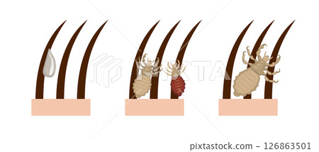 Illustration of a head louse with nits attached to hair strands Illustration of a head louse with nits attached to hair strands 126863501