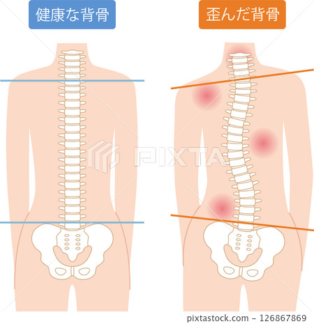 脊椎扭曲 正常脊椎 女性 脊椎扭曲 正常脊椎 女性 126867869