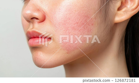 Close-Up of a Woman's Face with Redness and Skin Irritation Highlighting Skin Conditions and Dermatological Issues 126872181
