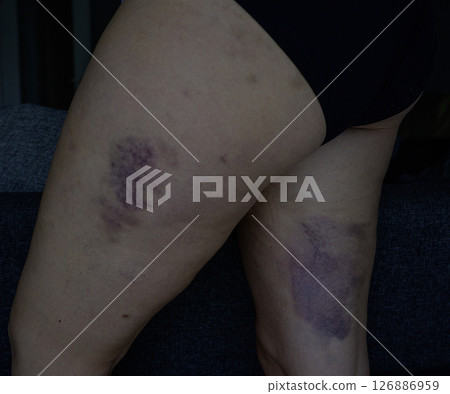 Bruises on the hips and thighs after cellulite treatments 126886959