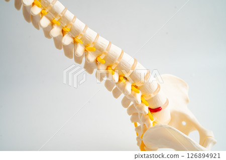 Lumbar spine displaced herniated disc fragment, spinal nerve and bone. Model for treatment medical in the orthopedic department. 126894921