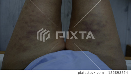 Bruises on the hips and thighs after cellulite treatments Bruises on the hips and thighs after cellulite treatments 126898854