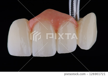 Naturally dental bridge with artificial gum made of zirconium for fixation to frontal upper teeth. 126901721