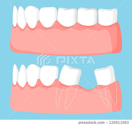 Dental Health and Tooth Extraction Illustration 126911083