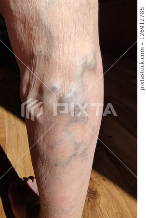 The varicose veins on a legs of old woman closeup 126912788