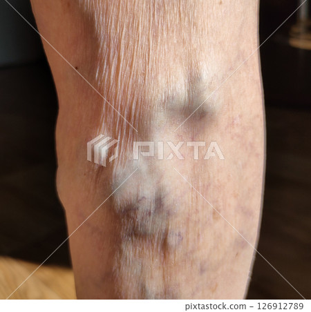 The varicose veins on a legs of old woman closeup 126912789