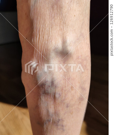 The varicose veins on a legs of old woman closeup 126912790