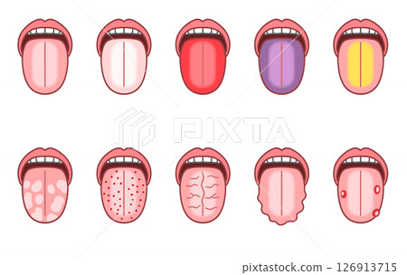 舌診，舌頭有各種症狀 126913715
