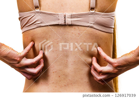 Woman with skin problem acne on back 126917039