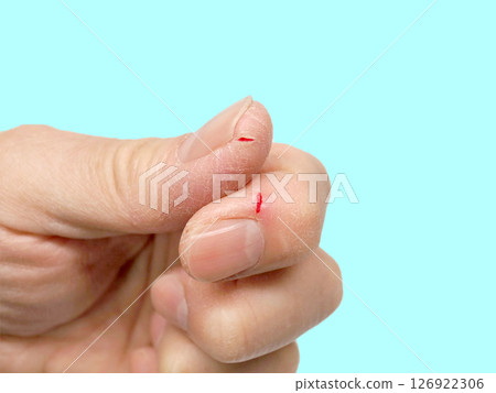 皮膚破裂、皸裂、乾燥、疼痛 126922306