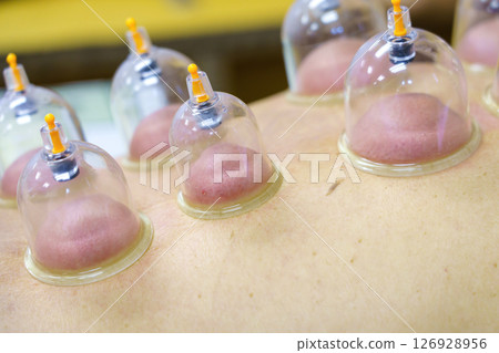 Close up for multiple vacuum cups, medical cupping therapy on human body. Doctor with cups for patient, therapy. Wellness, health injury rehabilitation concept. Alternative medicine Close up for multiple vacuum cups, medical cupping therapy on human body. Doctor with cups for patient, therapy. Wellness, health injury rehabilitation concept. Alternative medicine 126928956