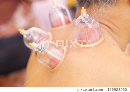 Close up for multiple vacuum cups, medical cupping therapy on human body. Doctor with cups for patient, therapy. Wellness, health injury rehabilitation concept. Alternative medicine 126928960