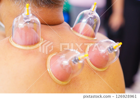 Close up for multiple vacuum cups, medical cupping therapy on human body. Doctor with cups for patient, therapy. Wellness, health injury rehabilitation concept. Alternative medicine 126928961