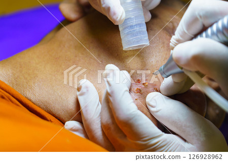 close up cosmetology procedure laser freckle skin removal on body parts. laser procedure. Cosmetic treatment in beauty clinic, resurfacing technique for wrinkles, scars and solar damage on skin close up cosmetology procedure laser freckle skin removal on body parts. laser procedure. Cosmetic treatment in beauty clinic, resurfacing technique for wrinkles, scars and solar damage on skin 126928962