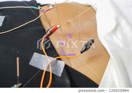 doctor sticks needles into the girl's back on acupuncture with Electrical stimulator 126928964