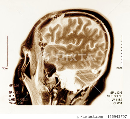 mri scan brain 126943797