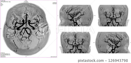 mri blood vessels 126943798