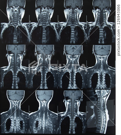 cervical spine x-ray film 126943866